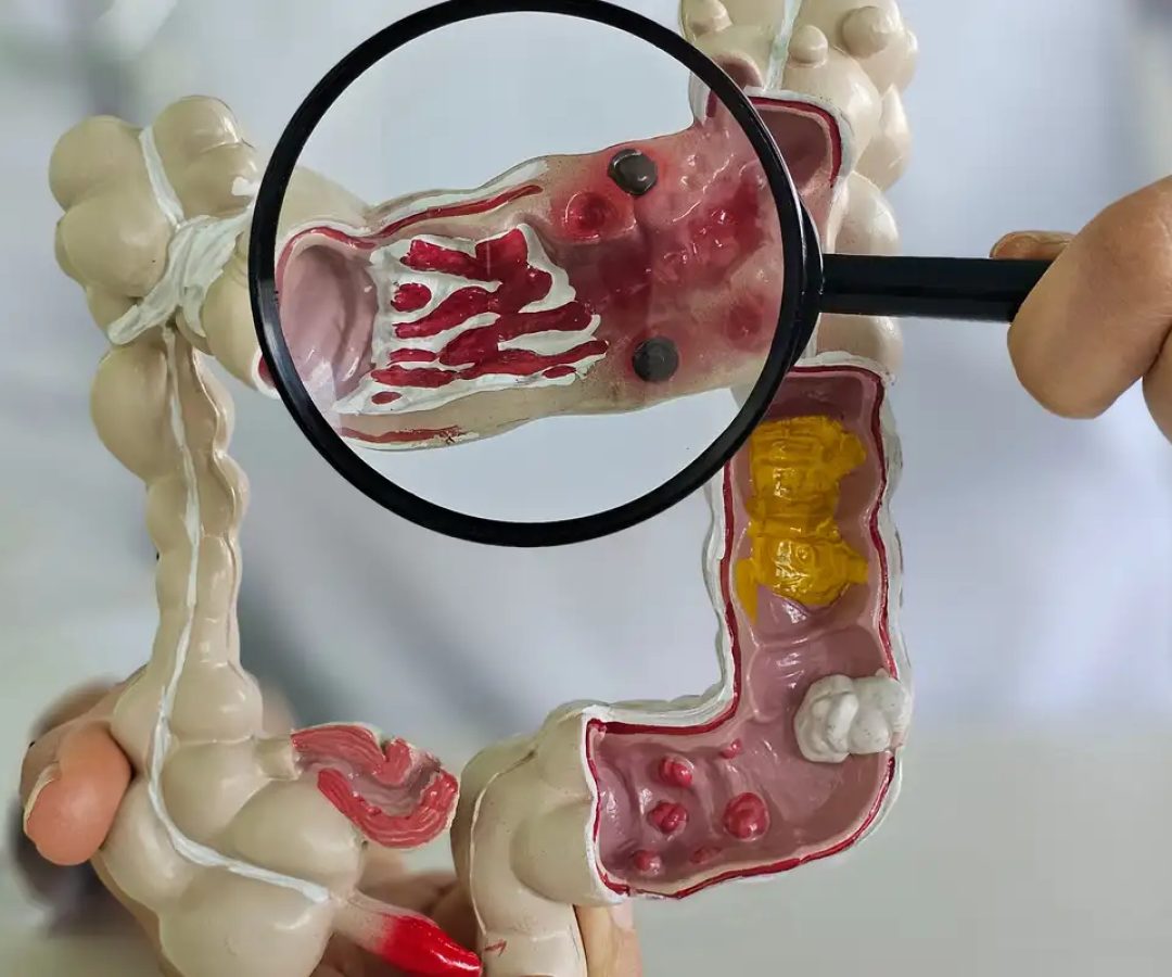 Em 13 anos, doença inflamatória intestinal cresce 5 vezes no Brasil