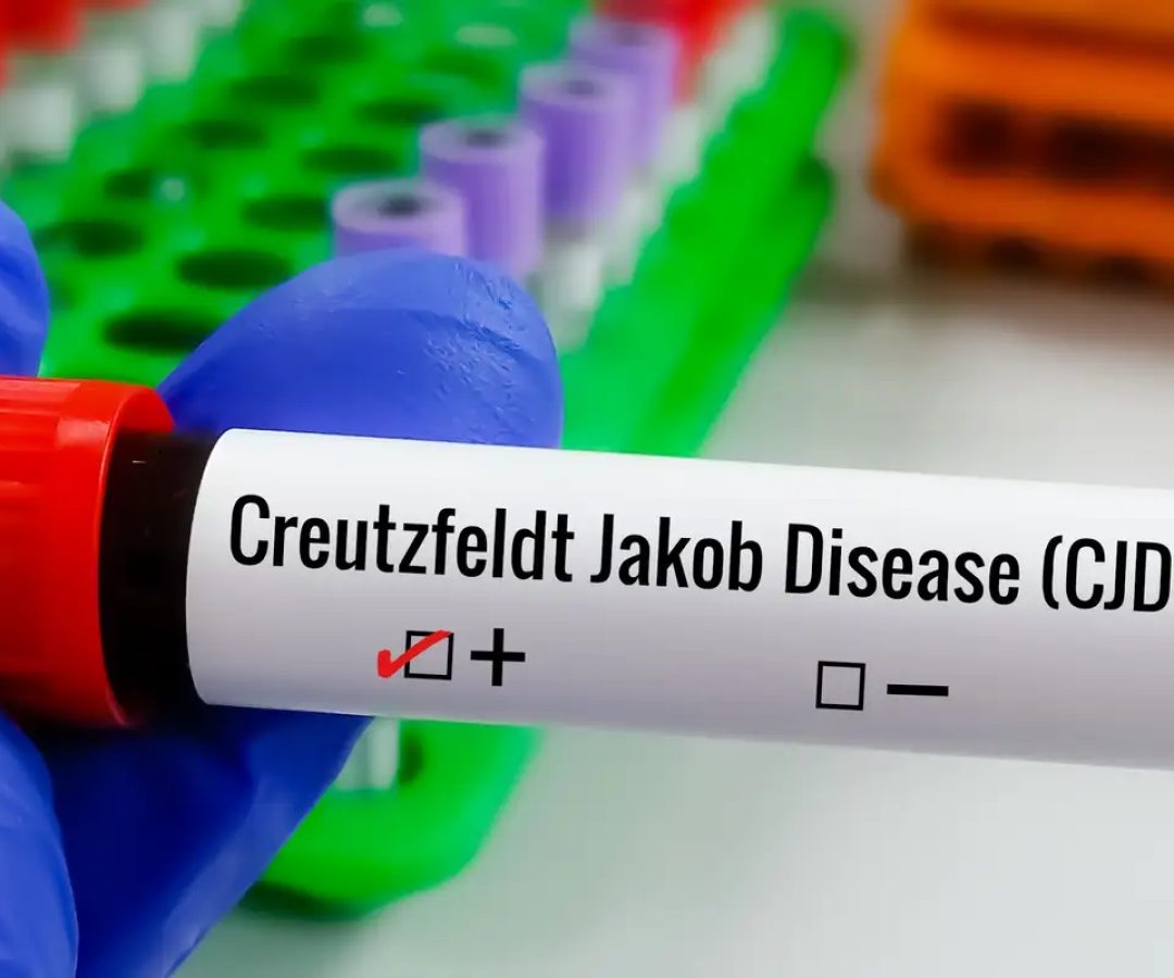 Entenda Doença de Creutzfeldt-Jakob, diagnóstico do piloto Lito Souza