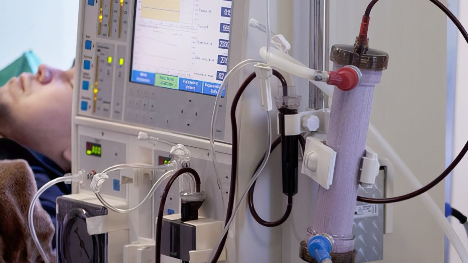 Estudo alerta para subdiagnóstico da doença renal crônica no Brasil
