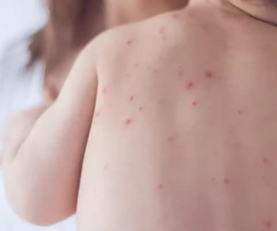 Estado de São Paulo reforça necessidade de vacinação contra o sarampo