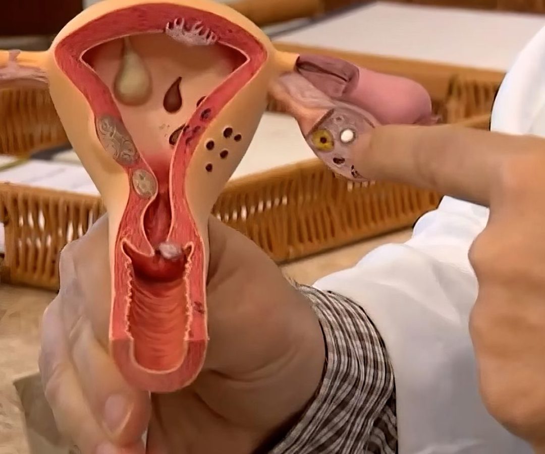 Aberta chamada pública para pesquisas sobre endometriose